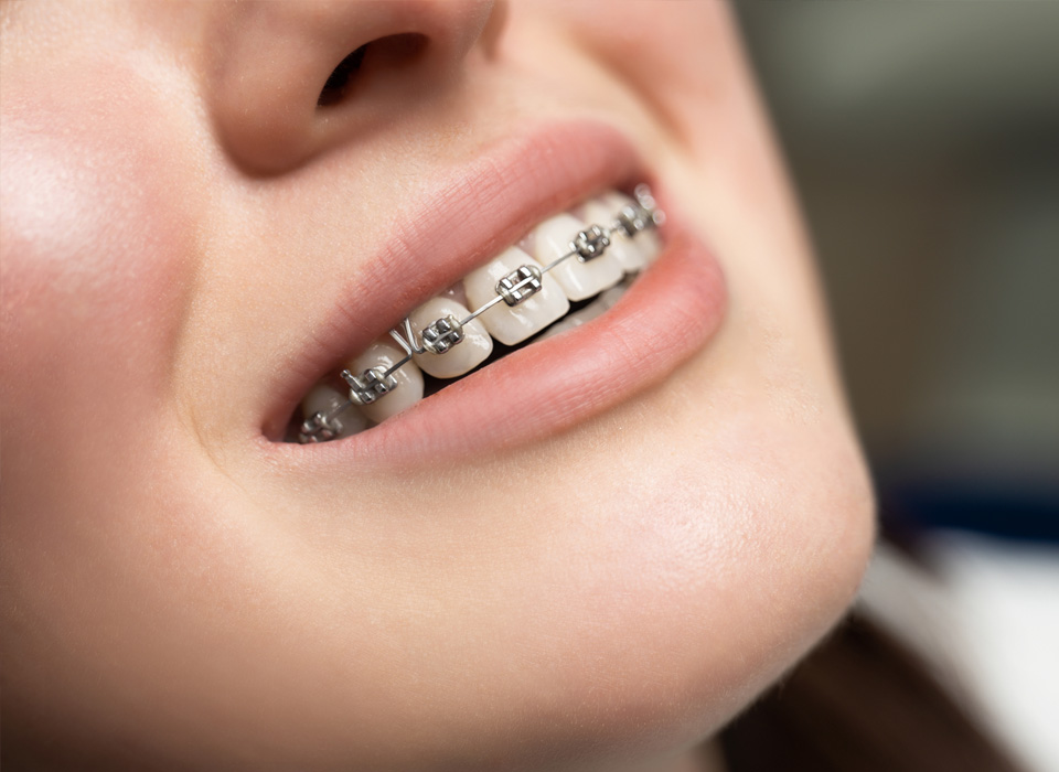 A woman with braces is smiling brightly, showcasing her joyful expression and confidence.