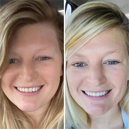 Before and after picture of a patient undergone Invisalign treatment