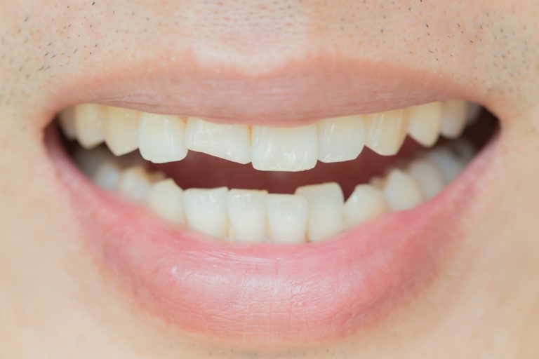 Close-up of a person's mouth showing a gap where a tooth is missing, highlighting dental health concerns.