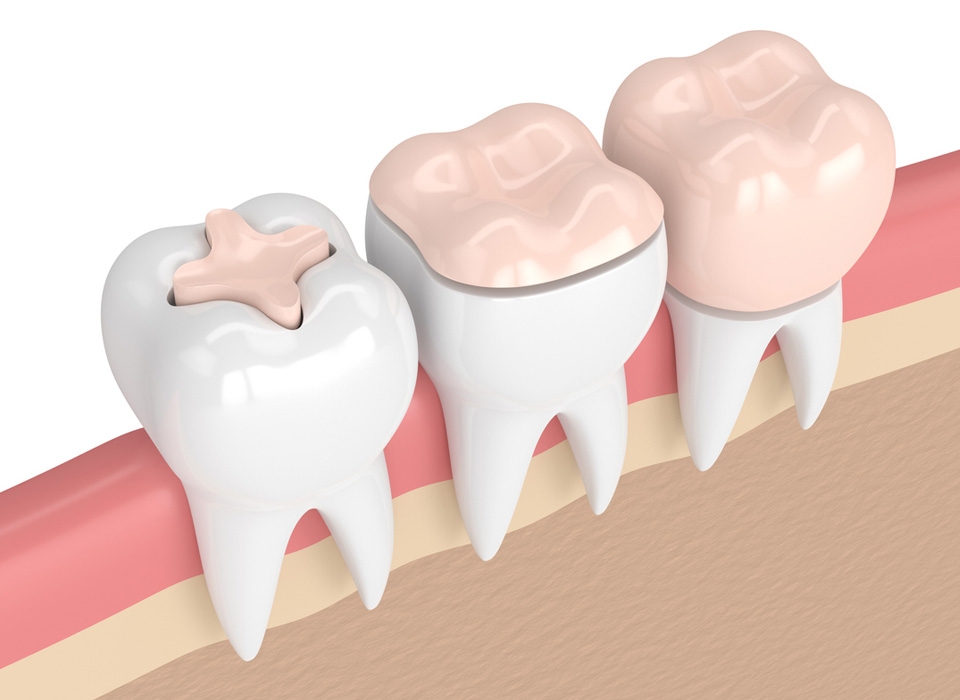 Two teeth are illustrated, both featuring crowns, highlighting their restoration and aesthetic enhancement in dental care.