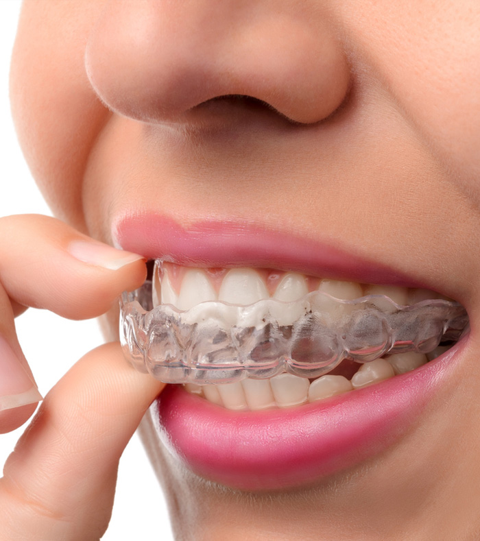 A woman smiling, showcasing her clear braces, highlighting her dental care and confidence.