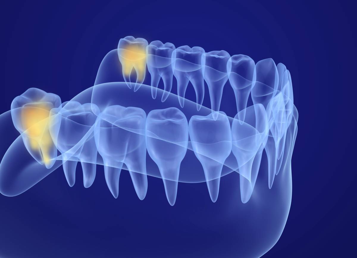 An image of a tooth displaying a distinct yellow area at its center, indicating potential dental issues.