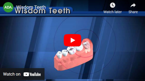 wisdom teeth video