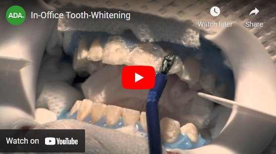 Tooth Whitening video