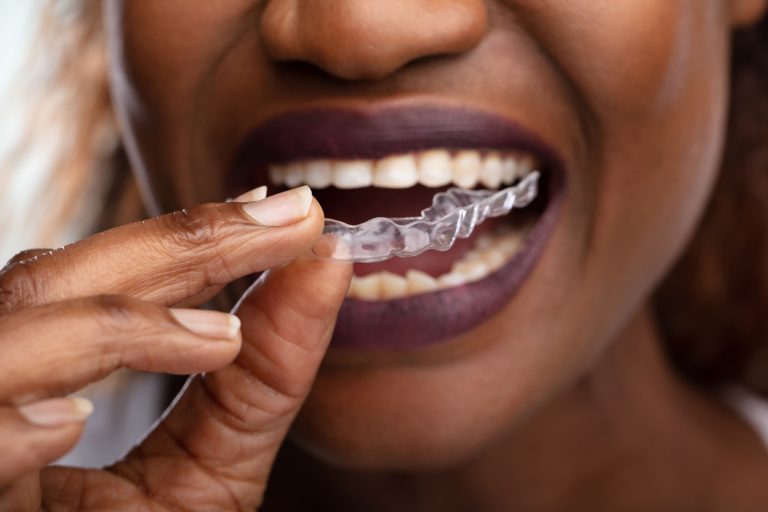 A woman with clear braces smiles while holding her teeth, showcasing her dental alignment and confidence.