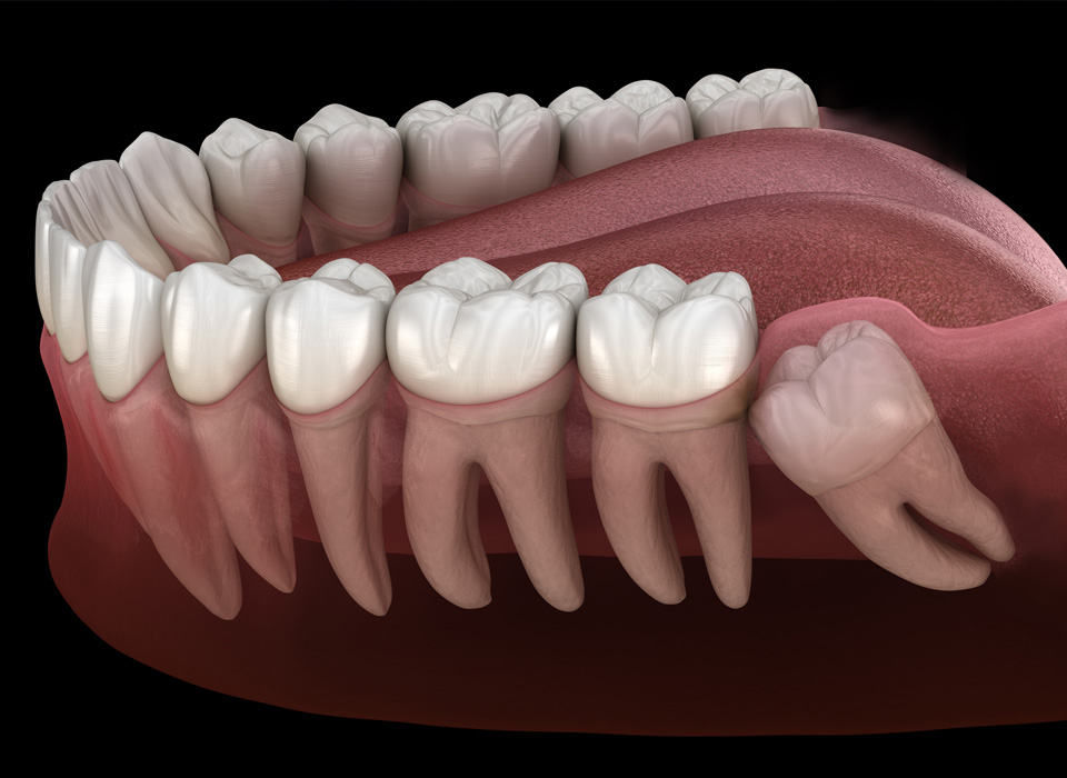 A visual representation of two teeth, each showing a gap where a tooth is missing, emphasizing dental concerns