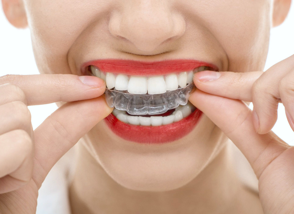 A woman smiling, showcasing her clear braces, highlighting her dental care and confidence.