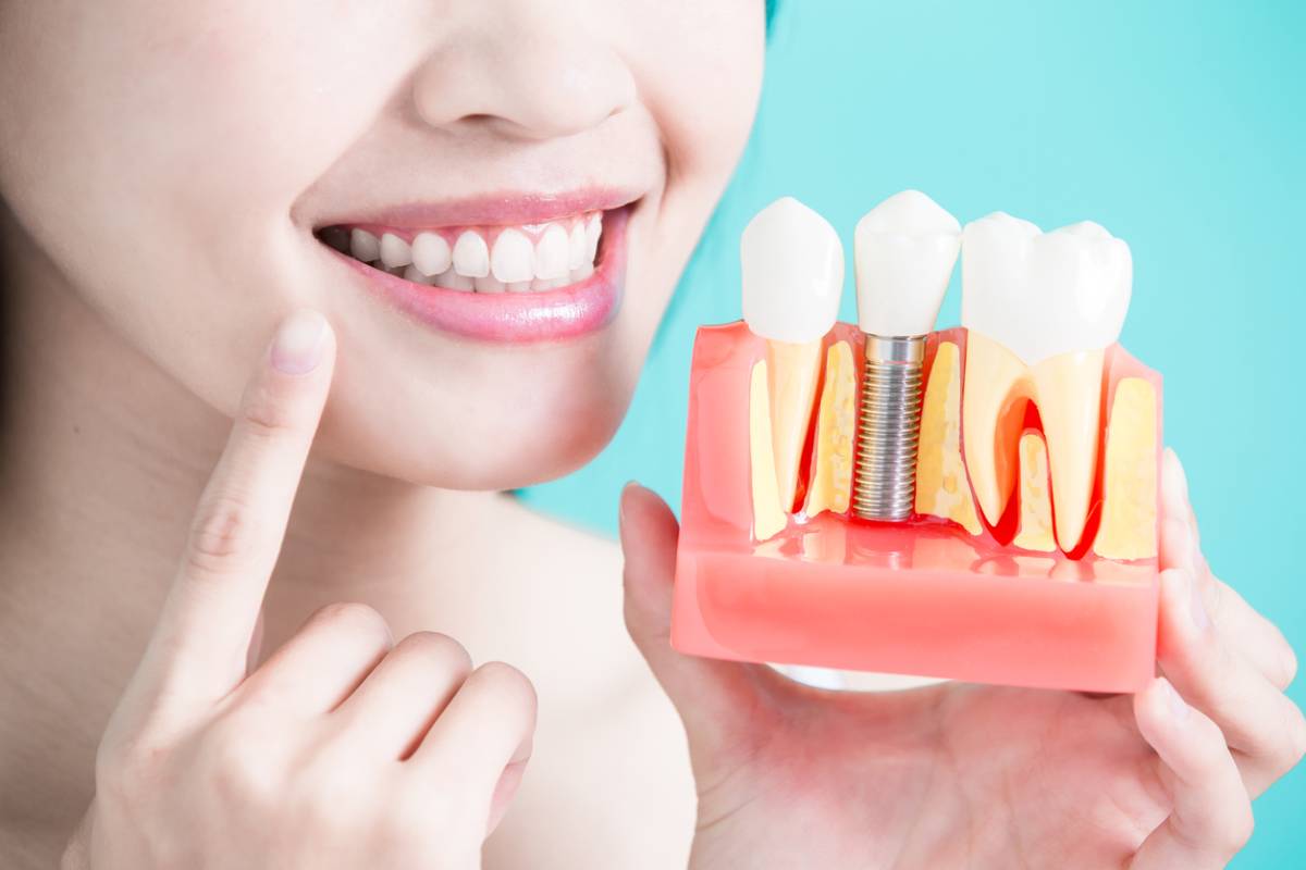 concept of reasons to invest in dental implants
