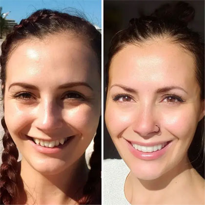 Before and after picture of a patient undergone Invisalign treatment