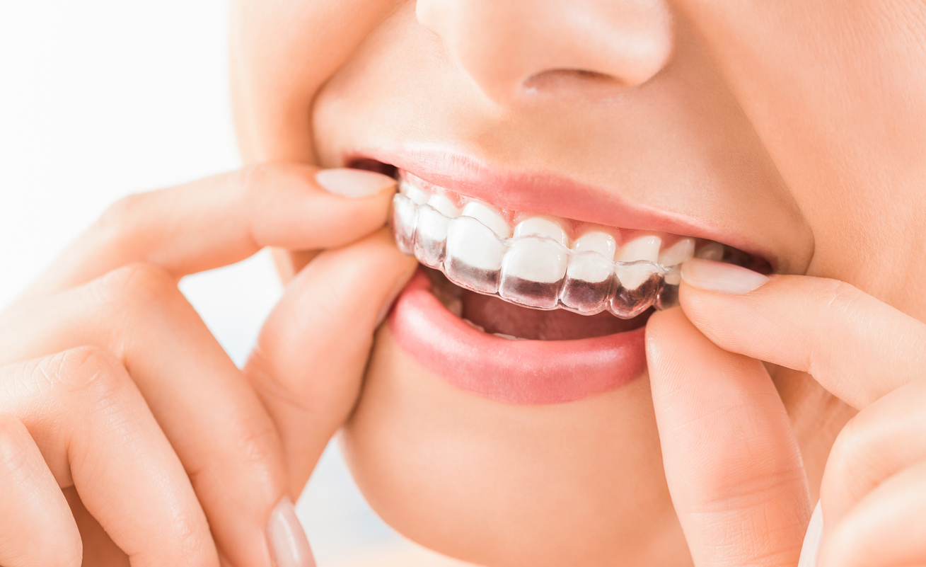 Your Options for a Whiter Smile | Cosmetic Dentist in Glendora