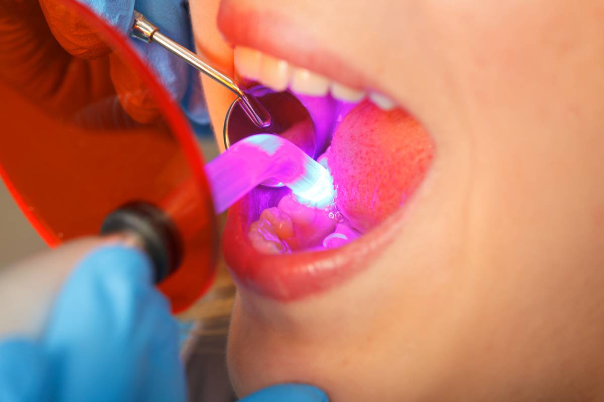 concept of how dental bonding improves your teeth