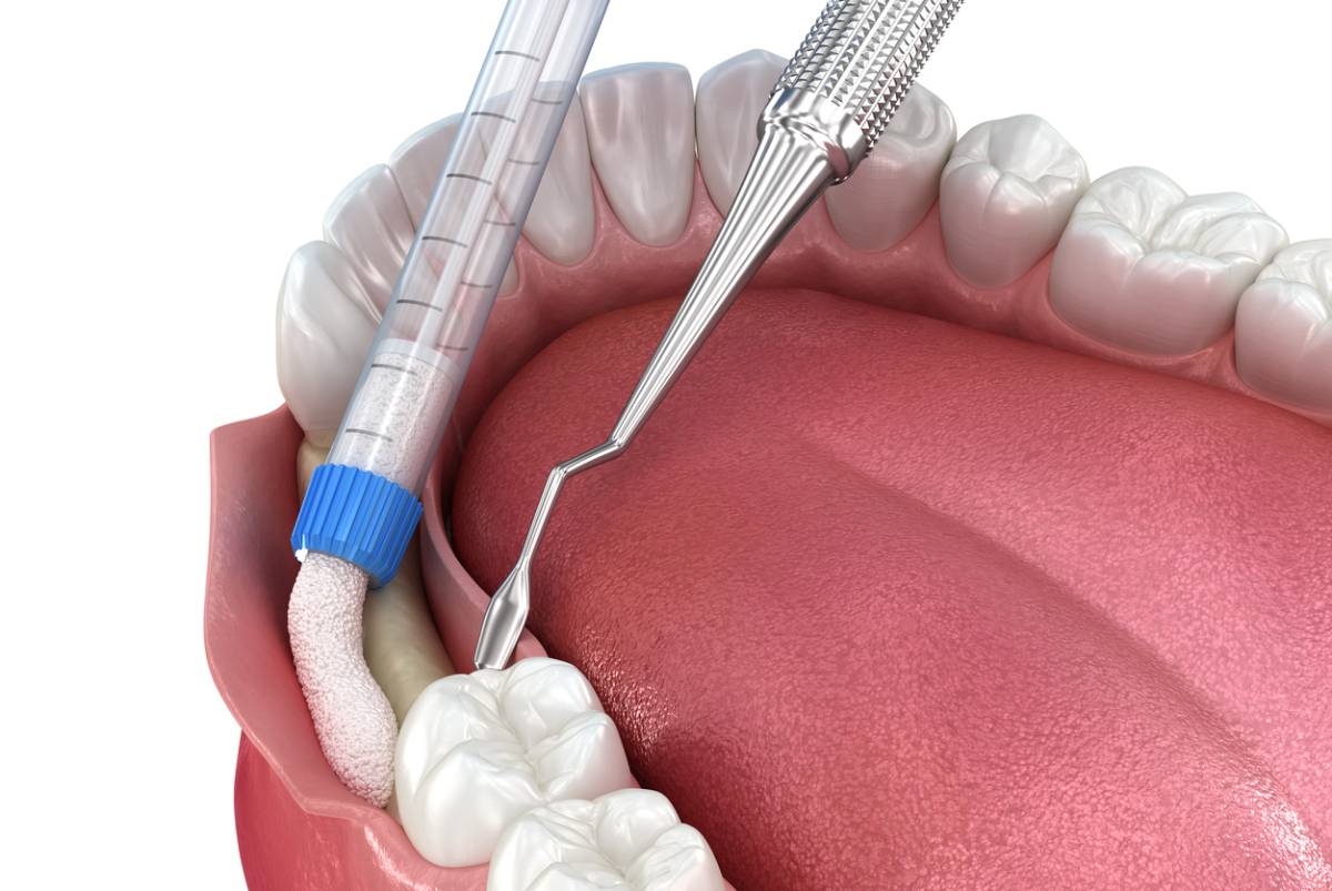 featured image for article asking is bone grafting painful