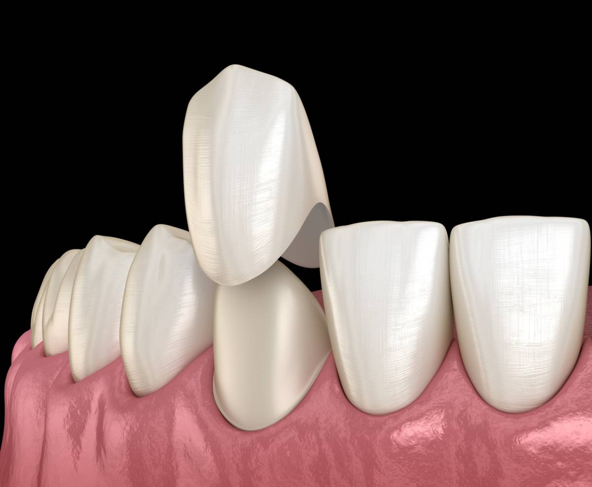 concept of dental crown fitting properly